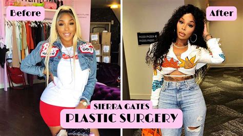 Sierra Gates Says Her Weight Loss Prompted Cosmetic Surgery。